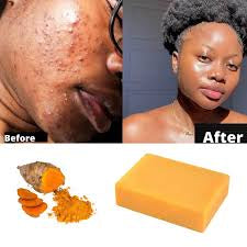 turmeric and kojic acid soap for dark spot